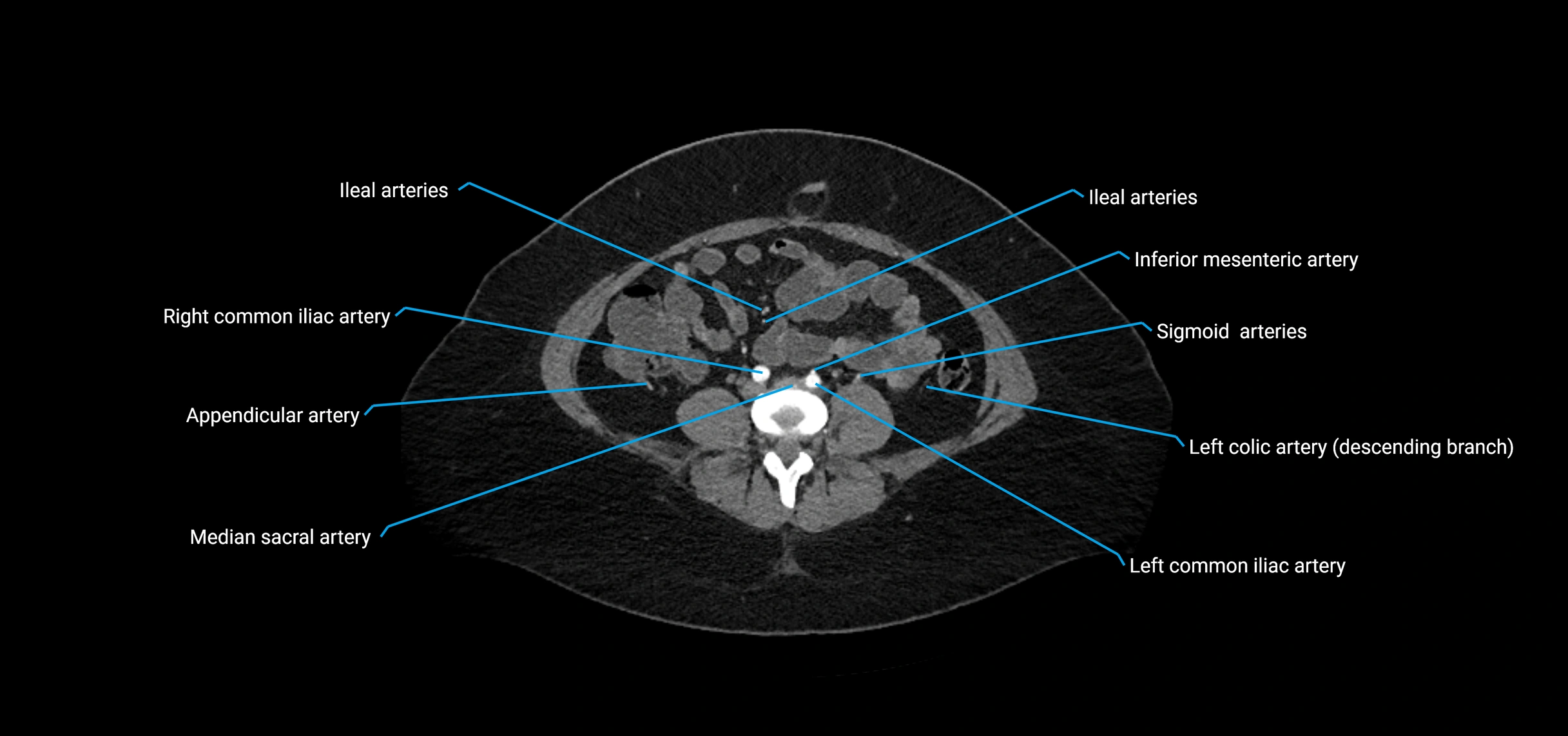CTA abdomen axial cross sectional anatomy labelled image_149 (2).webp